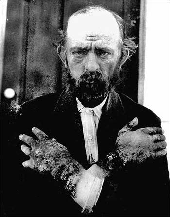 File:Pellagra NIH.jpg