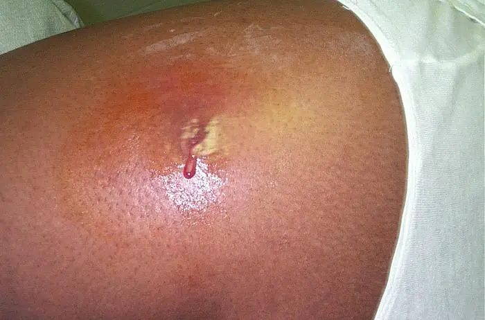 File:Cutaneous abscess MRSA staphylococcus aureus 7826 lores.jpg