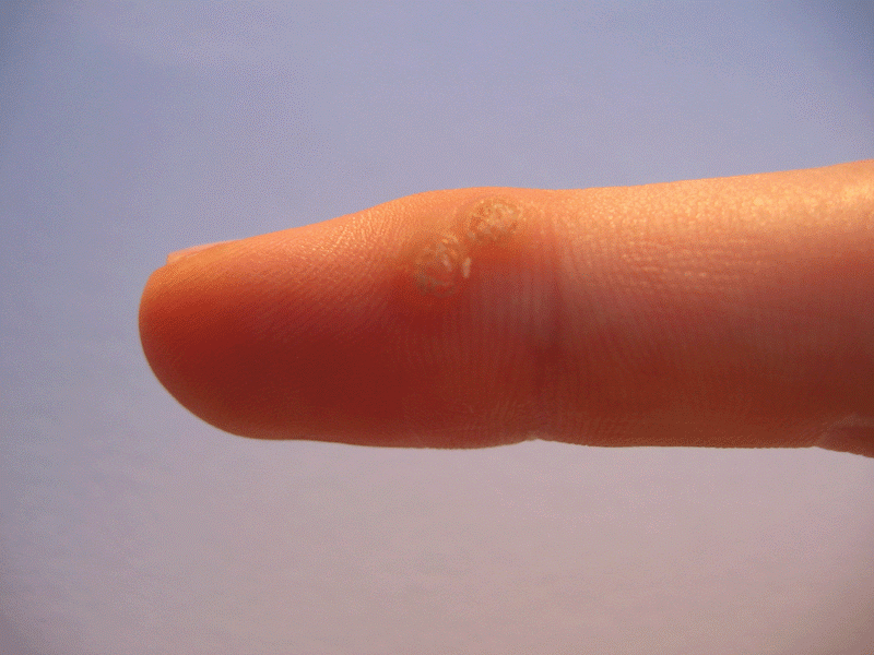 File:Wart ASA animated.gif
