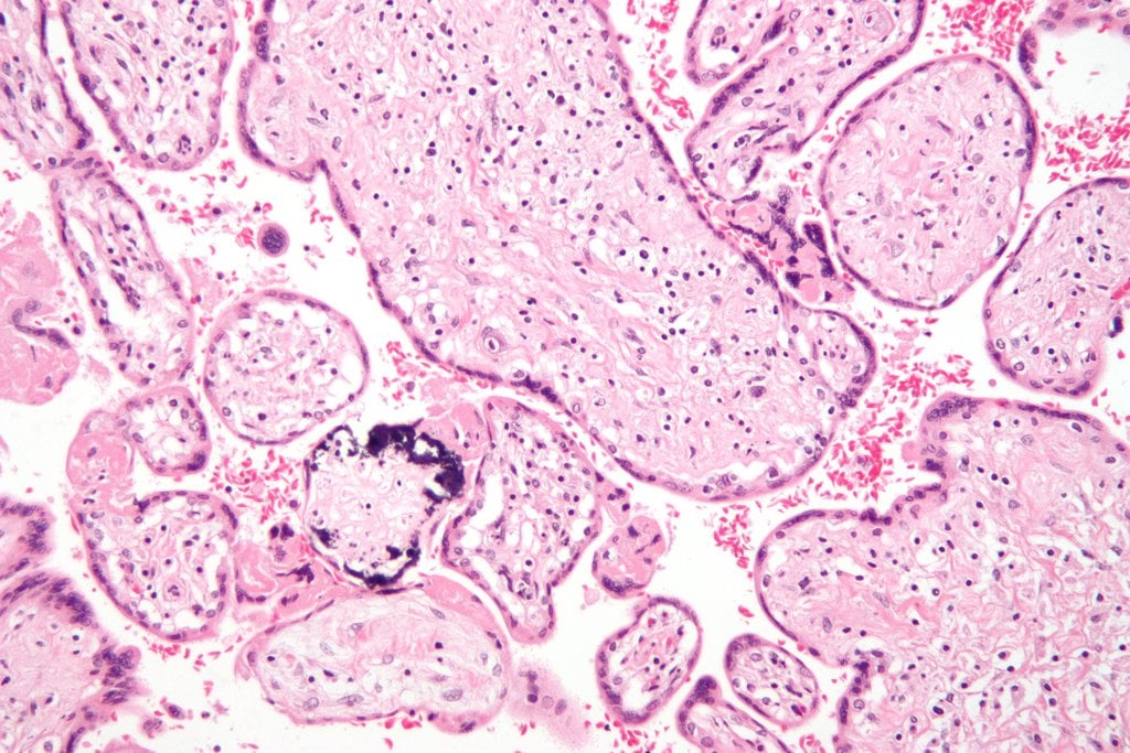 Micrograph of a placental infection (CMV placentitis).
