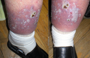 Example of a skin ulcer on the left leg