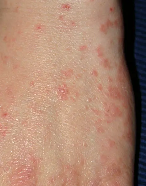 File:Acarodermatitis Hand.jpg