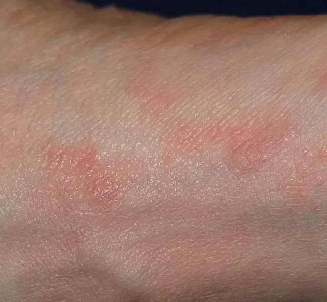 File:Acarodermatitis Fuß.jpg