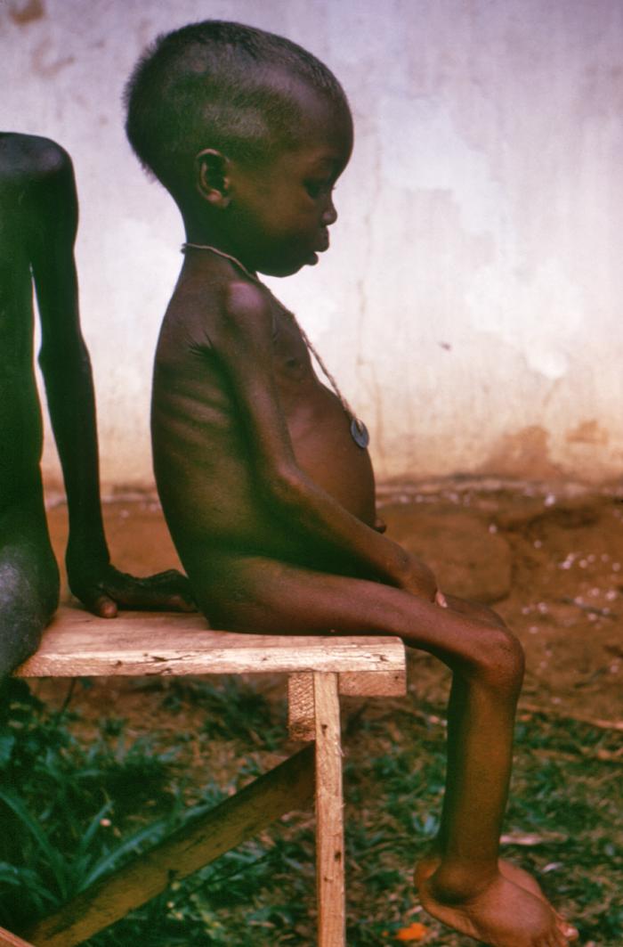Images such as this of a starving child in the international media generated sympathy for the plight of the Biagrans caused by the Nigerian blockade.
