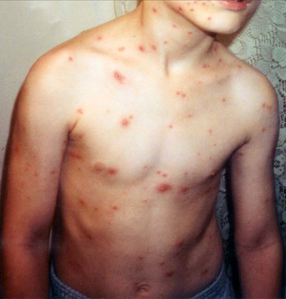 File:Child with chickenpox.jpg