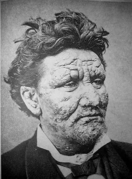 File:Leprosy.jpg