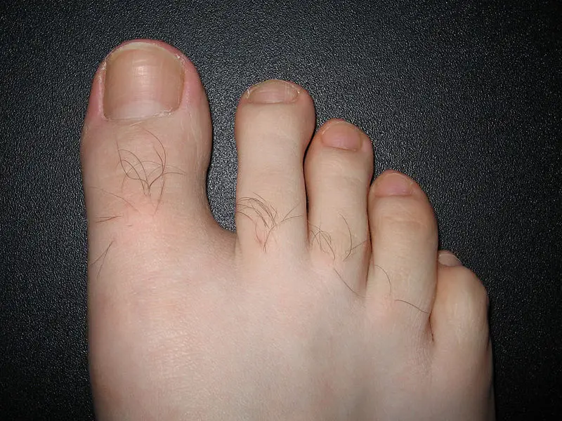 File:Toenails.jpg