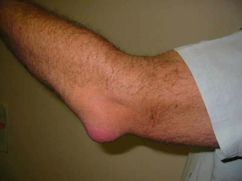 File:Bursitis Elbow WC.JPG