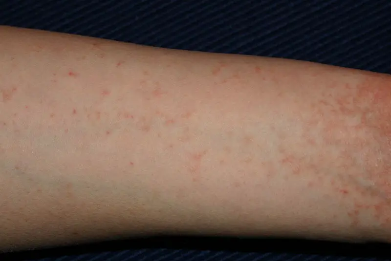 File:Acarodermatitis Arm.jpg