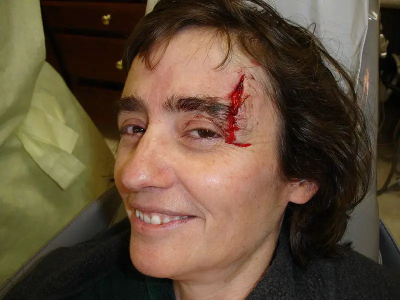 File:Bleeding.jpg