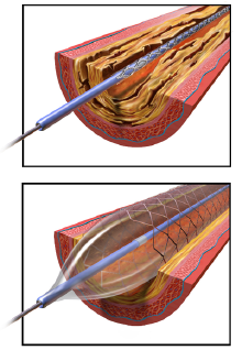 Angioplasty - Balloon Inflated with Stent.png