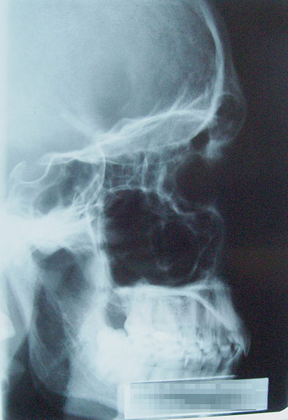 File:X-Ray Skull.jpg