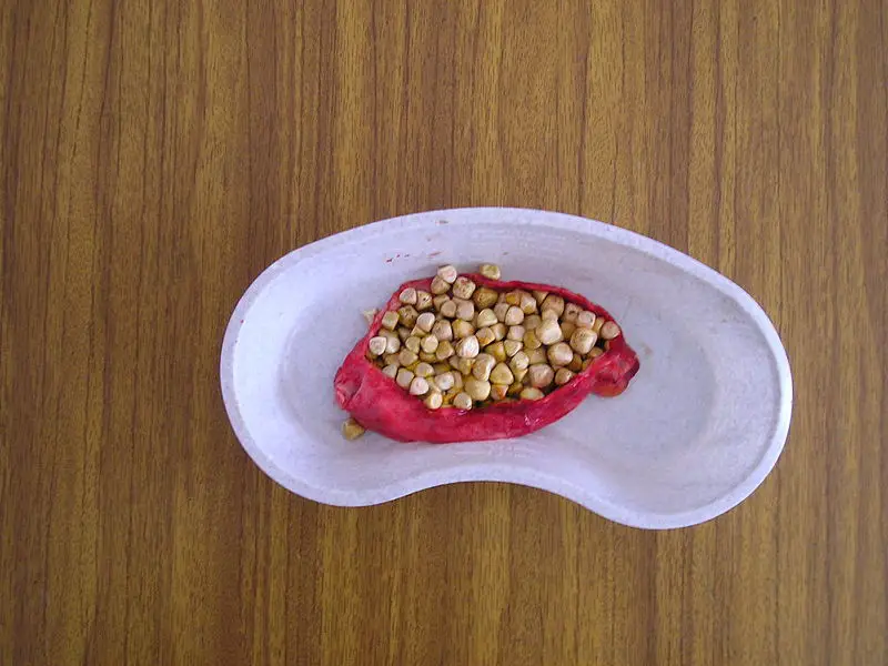 File:Gallstones.JPG