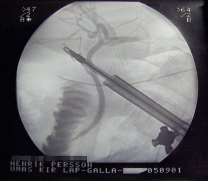 File:Laprascopy-Roentgen.jpg