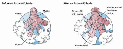 Asthma - New World Encyclopedia