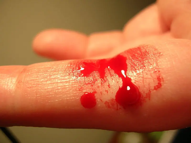 File:Bleeding finger.jpg