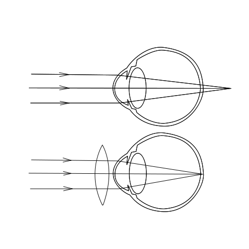 File:Hypermetropia.svg