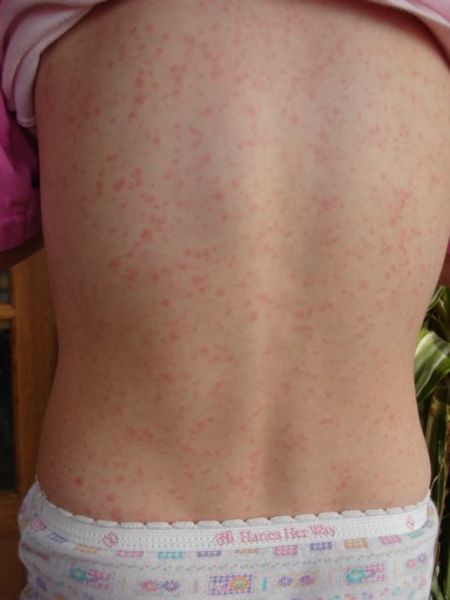 File:Scarlet fever 2.jpg